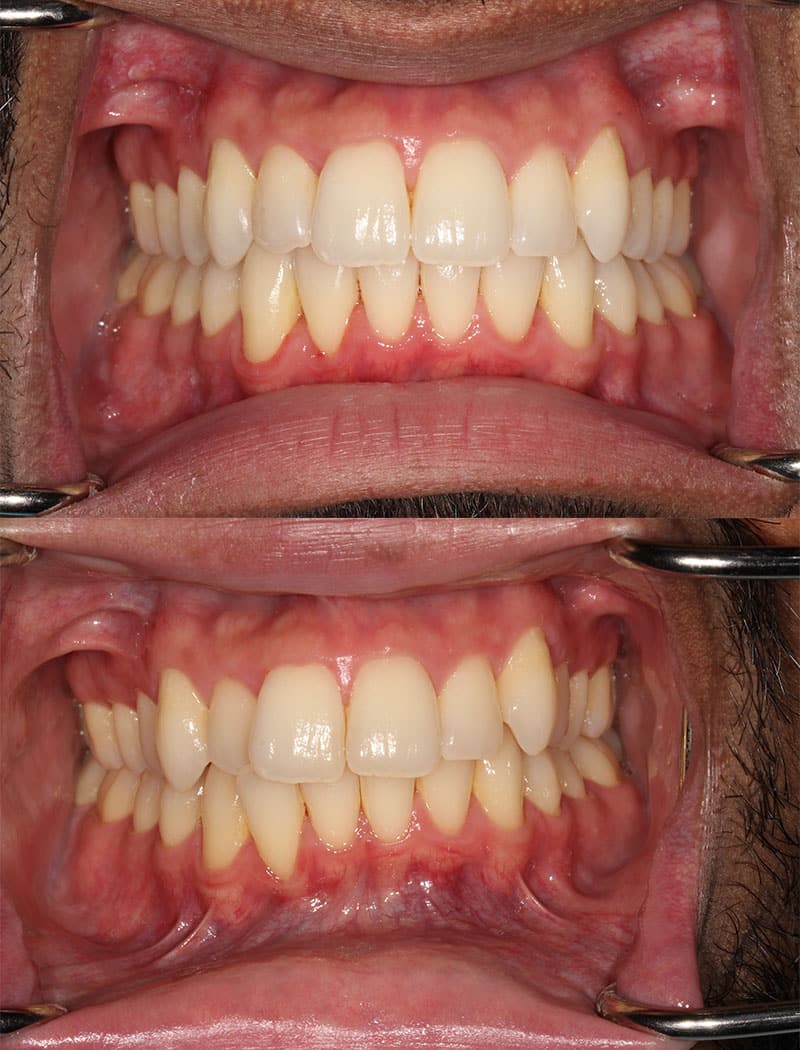 Invisalign-before-after