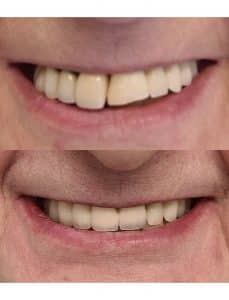 Full upper jaw rehabilitation with  bridges