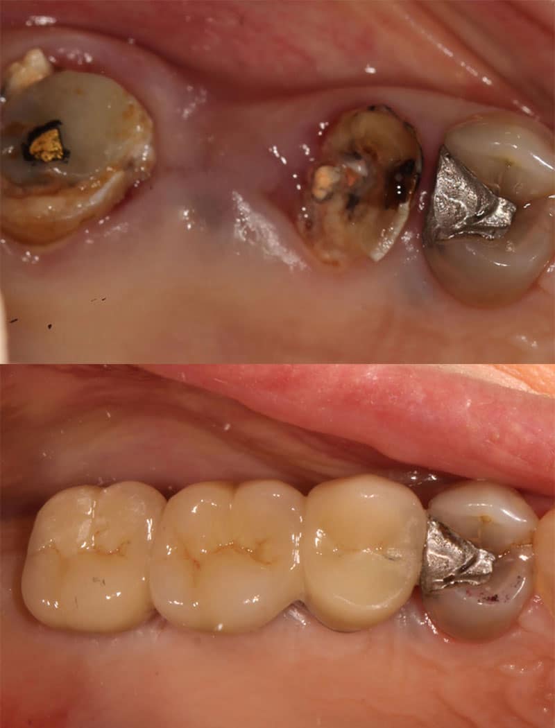 Implant Example 1