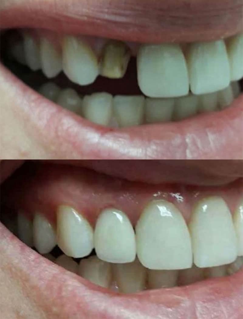 Veneers Example 1