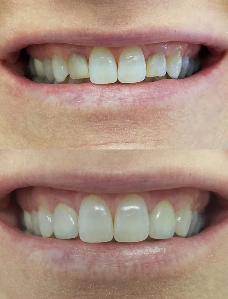 Veneers Example 1