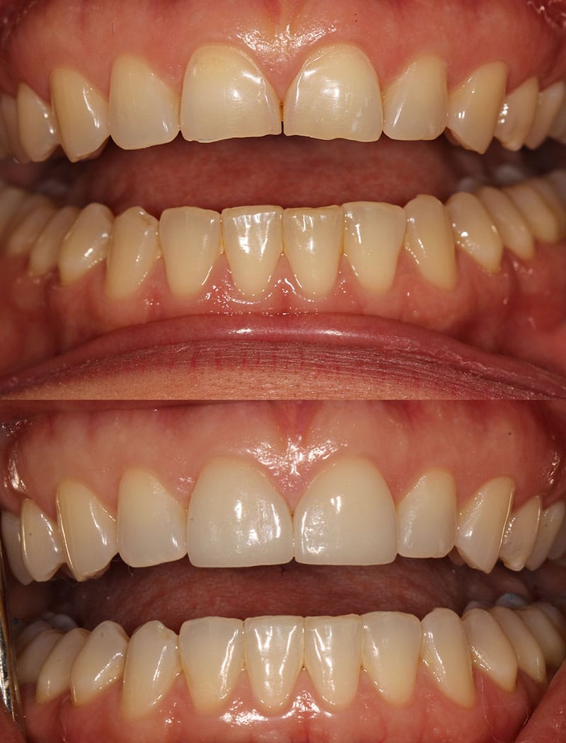 Veneers Example 1