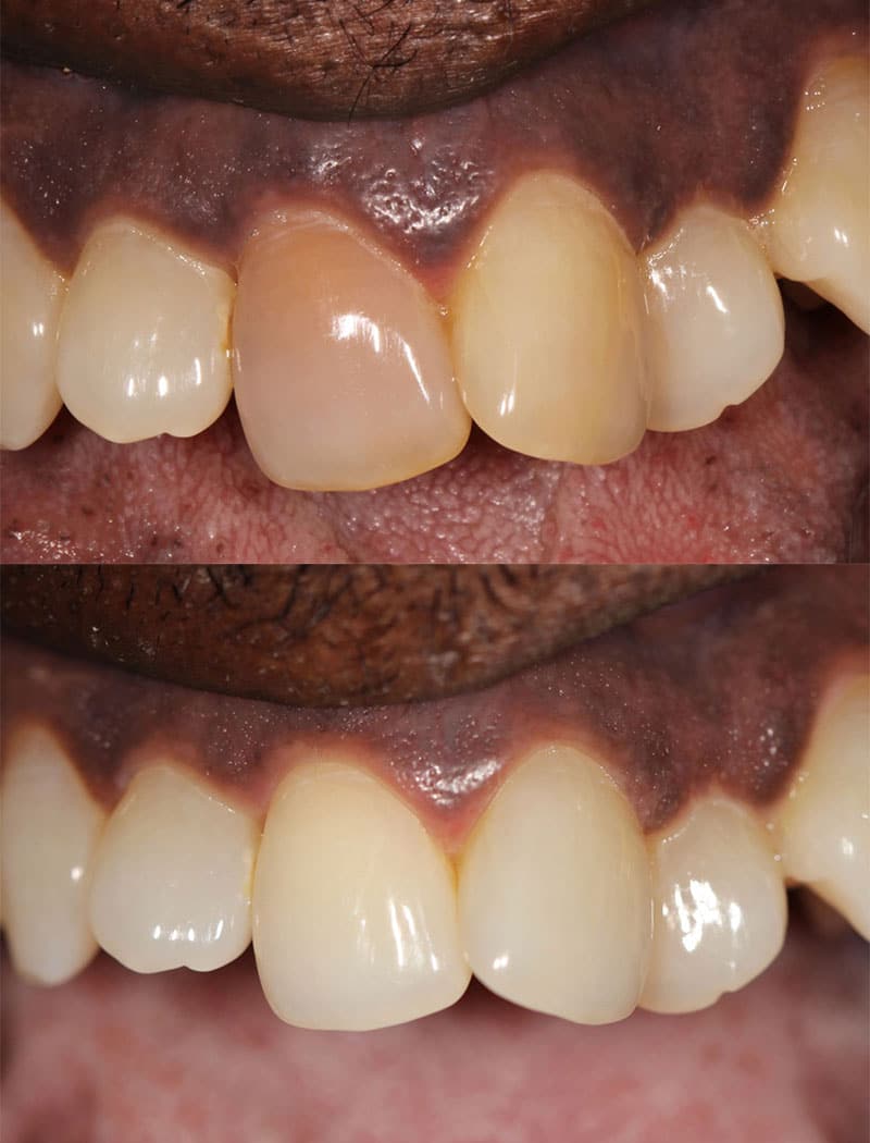 Whitening example