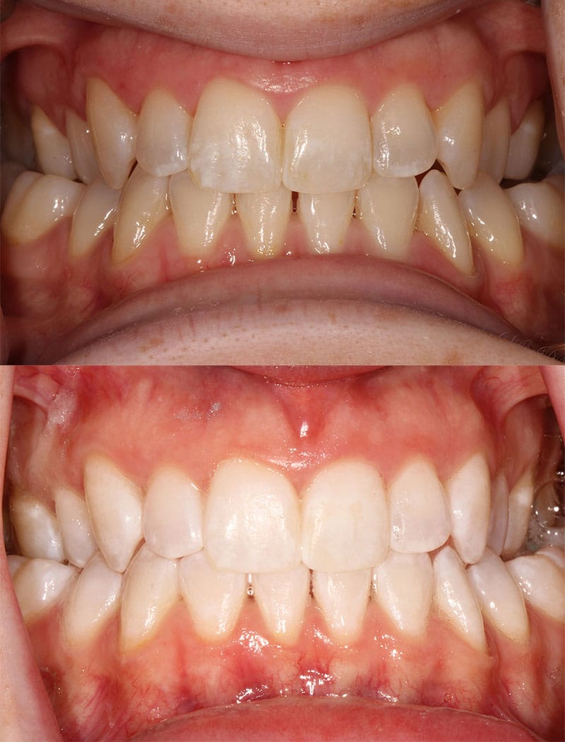 Whitening Example