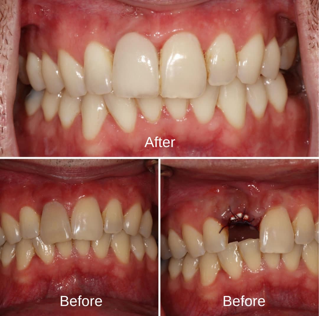 Implant Example 4
