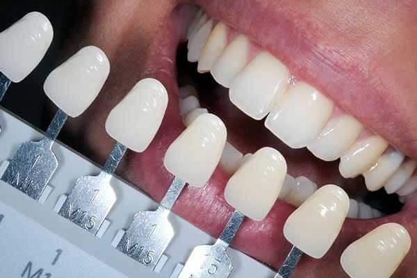 BPA Free Composite Fillings, White Fillings